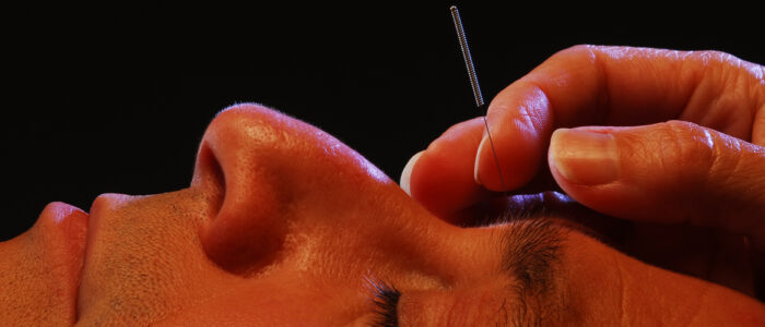 Facial Acupuncture in Sarasota Florida