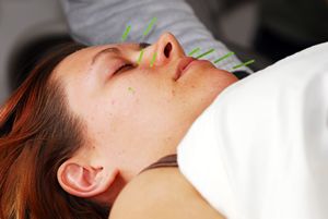 Acupuncture Facial Rejuvenation