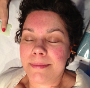 face with rosacea treated by michelle gellis
