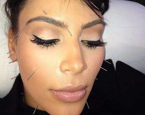 kim kardashian facial acupuncture