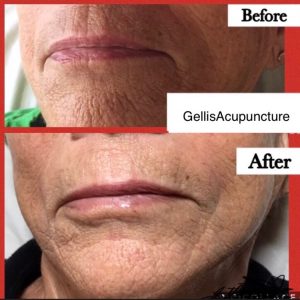 before and after photo of gellis acupuncture chin