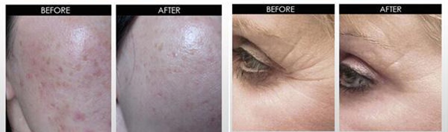 Before and After photos showing results from facial microneedling for hyperpigmentation and anti-wrinkle treatment